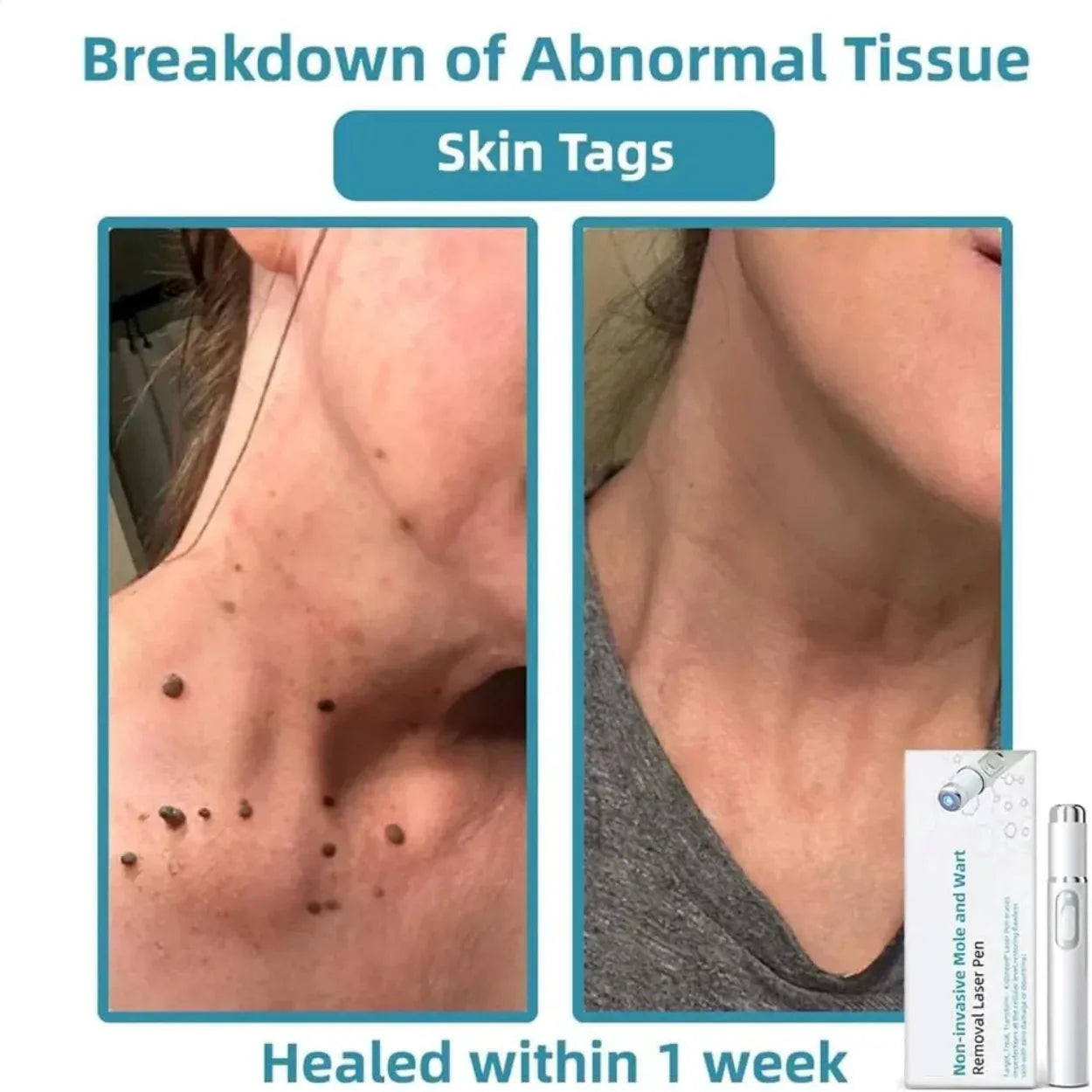 Glowzen™ – Remove Moles & Skin Tags Instantly at Home