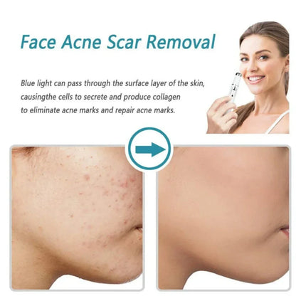 Glowzen™ – Remove Moles & Skin Tags Instantly at Home